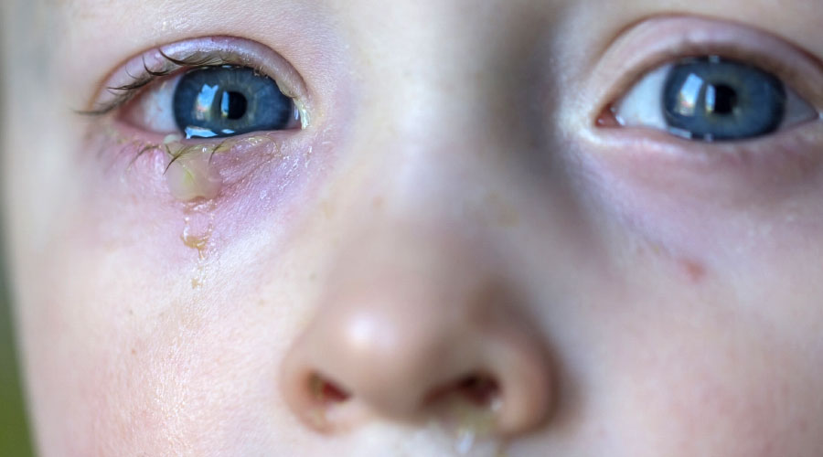Mon enfant a une conjonctivite : que faire?