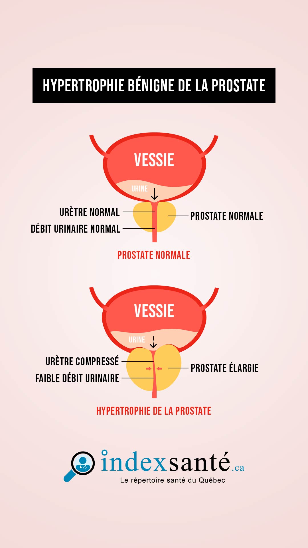Hypertrophie bénigne de la prostate (HBP) (infographie)