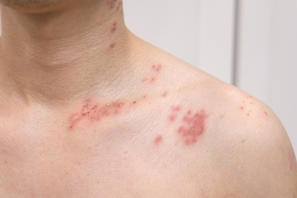 La Société canadienne de l’eczéma illumine le pays pour sensibiliser à l’eczéma en novembre